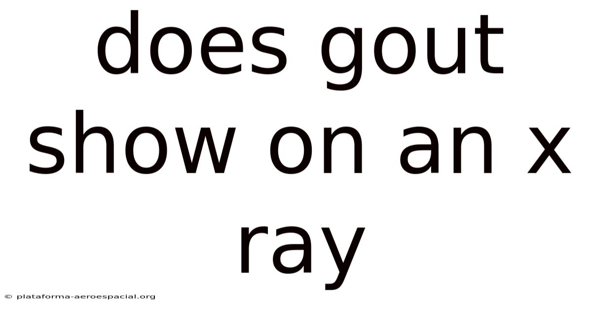 Does Gout Show On An X Ray
