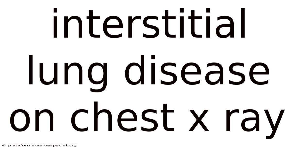 Interstitial Lung Disease On Chest X Ray