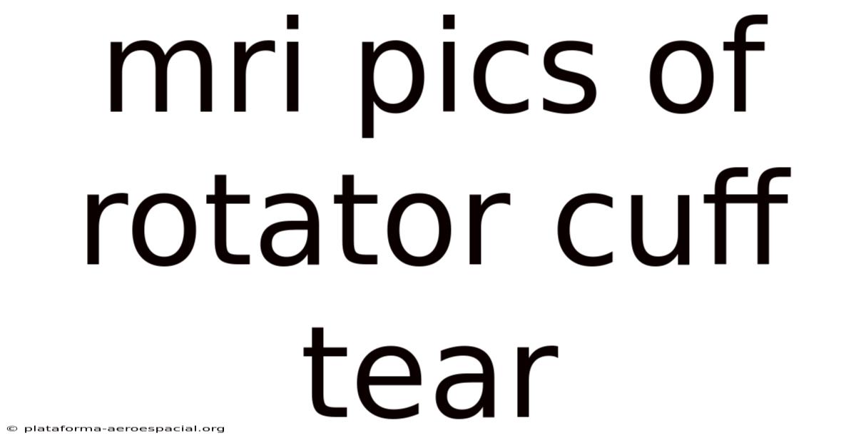 Mri Pics Of Rotator Cuff Tear