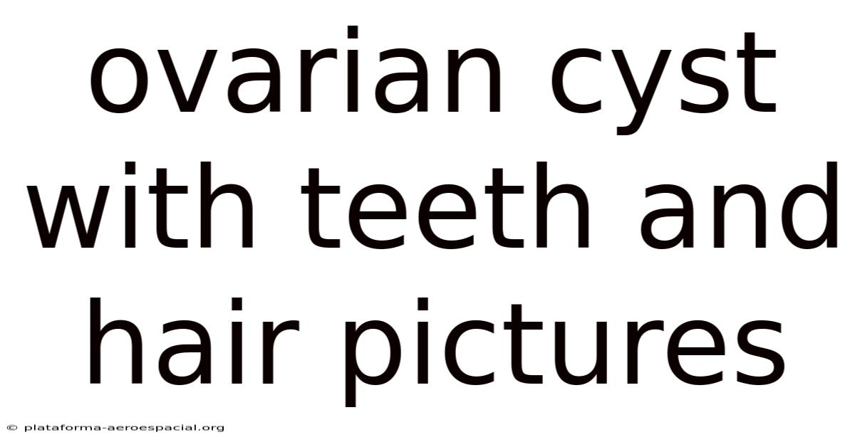Ovarian Cyst With Teeth And Hair Pictures